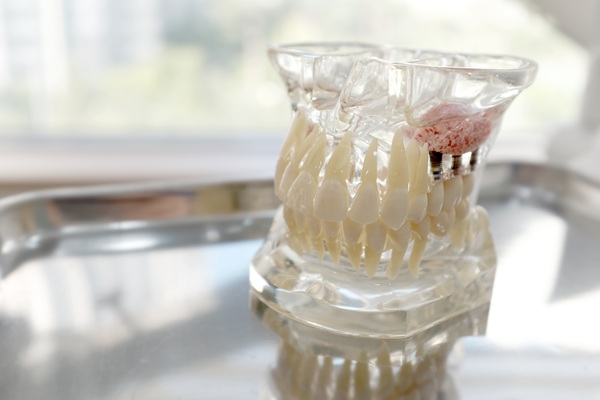 When Bone Grafting Is Needed For Dental Implants